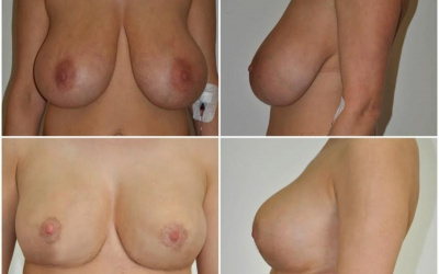 Galéria - obrázky / Zmenšenie prsníkov - foto Galéria - obrázky / Zmenšenie prsníkov - foto