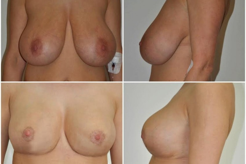 Galéria - obrázky / Zmenšenie prsníkov - foto Galéria - obrázky / Zmenšenie prsníkov - foto