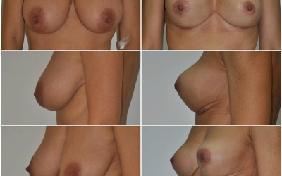 Galéria - obrázky / Zmenšenie prsníkov - foto Galéria - obrázky / Zmenšenie prsníkov - foto