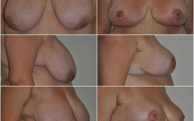 Galéria - obrázky / Zmenšenie prsníkov - foto Galéria - obrázky / Zmenšenie prsníkov - foto