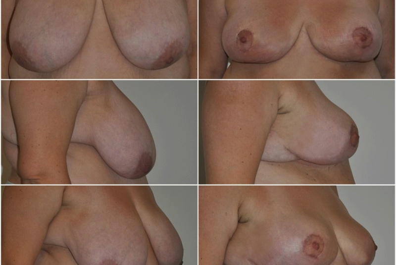 Galéria - obrázky / Zmenšenie prsníkov - foto Galéria - obrázky / Zmenšenie prsníkov - foto