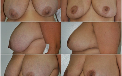 Galéria - obrázky / Zmenšenie prsníkov - foto Galéria - obrázky / Zmenšenie prsníkov - foto