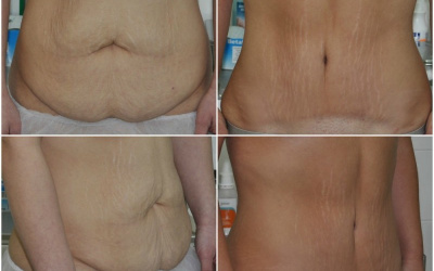 Galéria - obrázky / Plastika brucha - foto Galéria - obrázky / Plastika brucha - foto