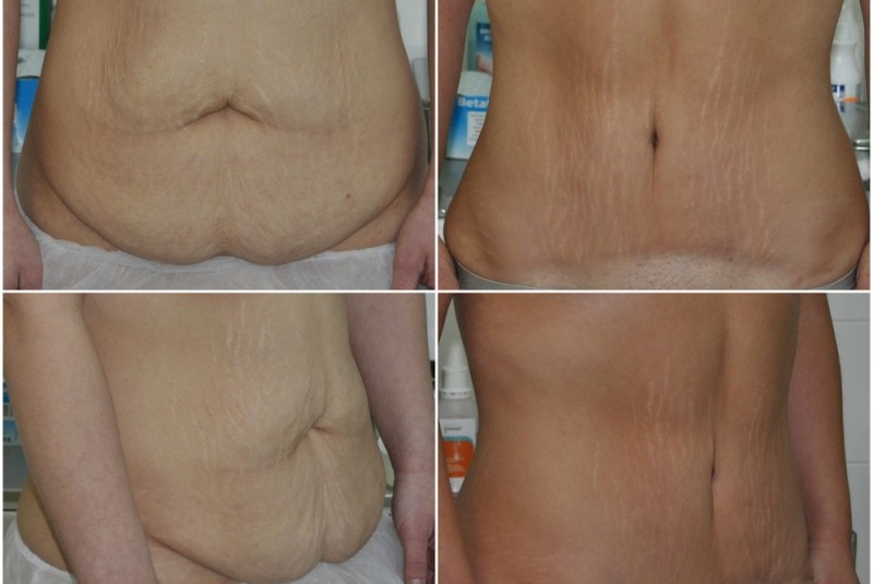 Galéria - obrázky / Plastika brucha - foto Galéria - obrázky / Plastika brucha - foto