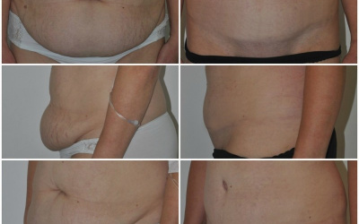 Galéria - obrázky / Plastika brucha - foto Galéria - obrázky / Plastika brucha - foto