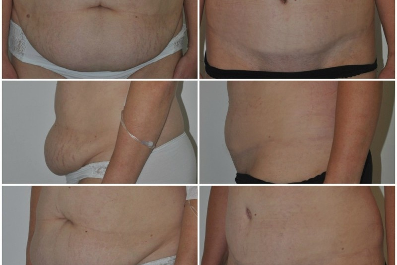 Galéria - obrázky / Plastika brucha - foto Galéria - obrázky / Plastika brucha - foto