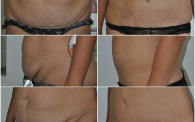 Galéria - obrázky / Plastika brucha - foto Galéria - obrázky / Plastika brucha - foto