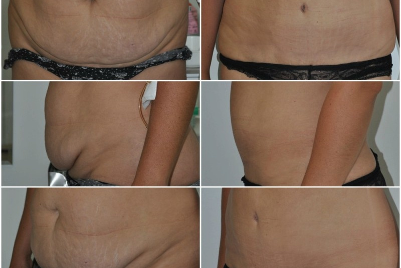 Galéria - obrázky / Plastika brucha - foto Galéria - obrázky / Plastika brucha - foto