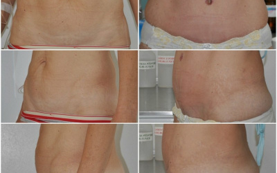 Galéria - obrázky / Plastika brucha - foto Galéria - obrázky / Plastika brucha - foto