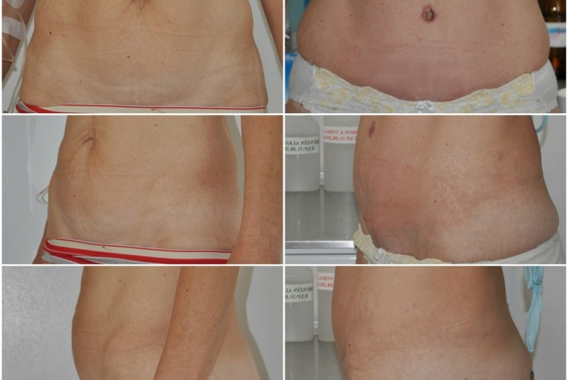 Galéria - obrázky / Plastika brucha - foto Galéria - obrázky / Plastika brucha - foto