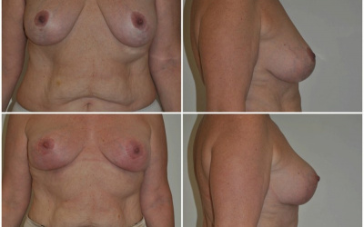 Galéria - obrázky / Spevnenie poprsia - foto Galéria - obrázky / Spevnenie poprsia - foto