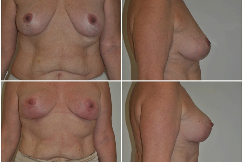 Galéria - obrázky / Spevnenie poprsia - foto Galéria - obrázky / Spevnenie poprsia - foto