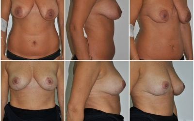 Galéria - obrázky / Spevnenie poprsia - foto Galéria - obrázky / Spevnenie poprsia - foto