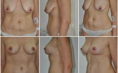 Galéria - obrázky / Spevnenie poprsia - foto Galéria - obrázky / Spevnenie poprsia - foto