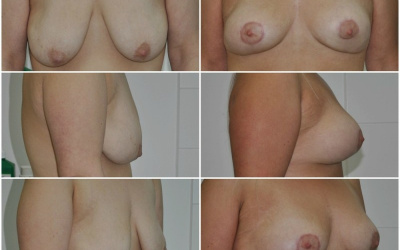 Galéria - obrázky / Spevnenie poprsia - foto Galéria - obrázky / Spevnenie poprsia - foto