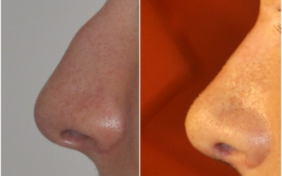 Galéria - obrázky / Plastika nosa - foto Galéria - obrázky / Plastika nosa - foto