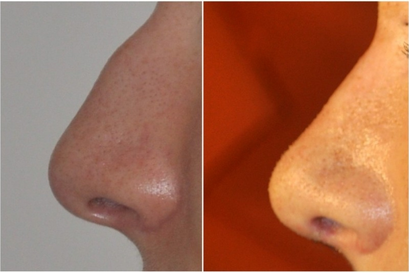 Galéria - obrázky / Plastika nosa - foto Galéria - obrázky / Plastika nosa - foto