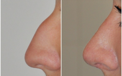 Galéria - obrázky / Plastika nosa - foto Galéria - obrázky / Plastika nosa - foto