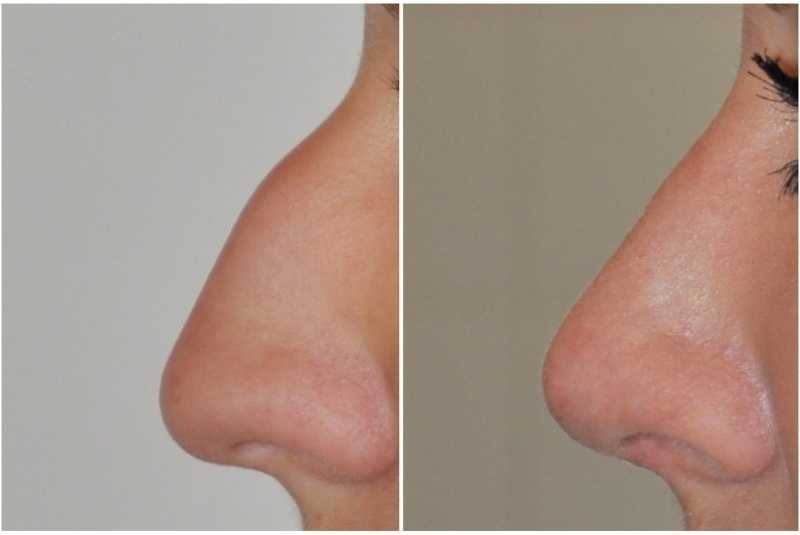 Galéria - obrázky / Plastika nosa - foto Galéria - obrázky / Plastika nosa - foto