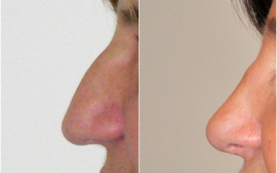 Galéria - obrázky / Plastika nosa - foto Galéria - obrázky / Plastika nosa - foto