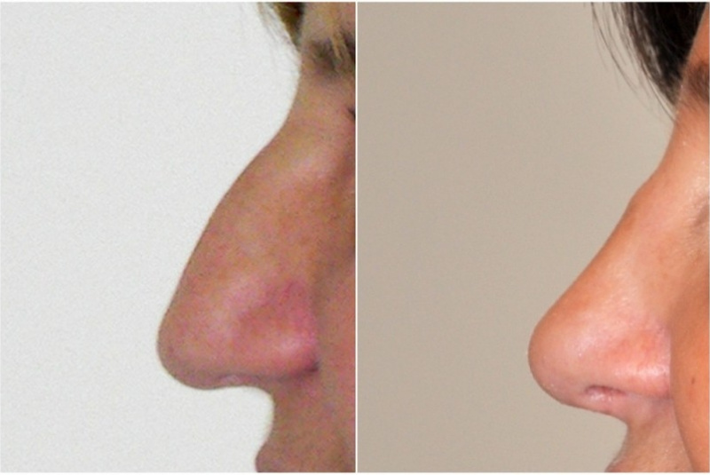 Galéria - obrázky / Plastika nosa - foto Galéria - obrázky / Plastika nosa - foto