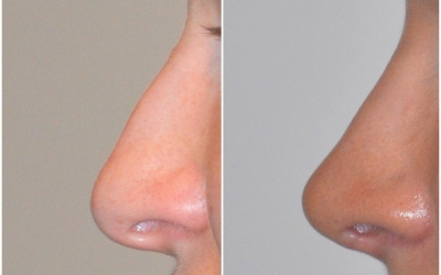 Galéria - obrázky / Plastika nosa - foto Galéria - obrázky / Plastika nosa - foto