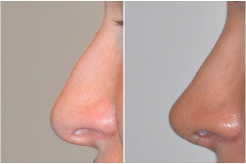 Galéria - obrázky / Plastika nosa - foto Galéria - obrázky / Plastika nosa - foto