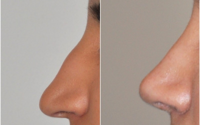 Galéria - obrázky / Plastika nosa - foto Galéria - obrázky / Plastika nosa - foto