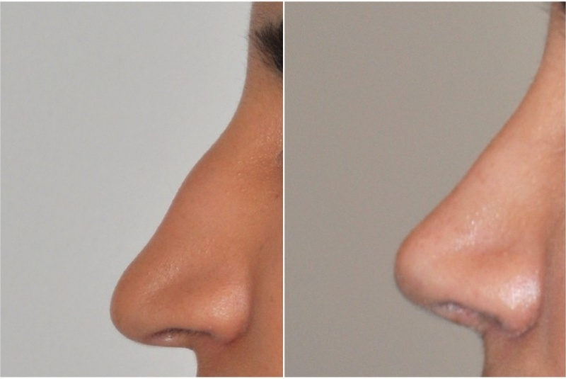 Galéria - obrázky / Plastika nosa - foto Galéria - obrázky / Plastika nosa - foto