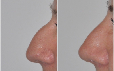 Galéria - obrázky / Plastika nosa - foto Galéria - obrázky / Plastika nosa - foto