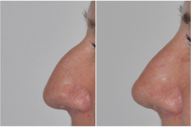 Galéria - obrázky / Plastika nosa - foto Galéria - obrázky / Plastika nosa - foto