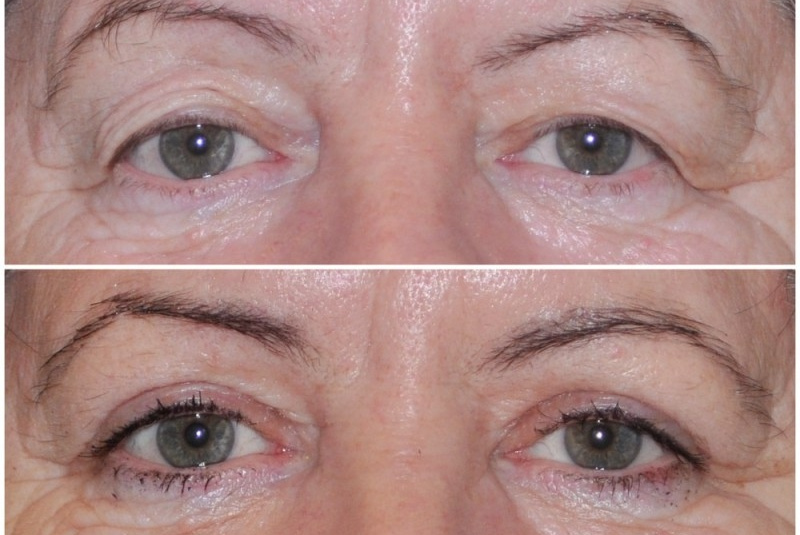 Galéria - obrázky / Operácia viečok - foto Galéria - obrázky / Operácia viečok - foto