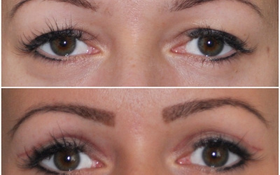 Galéria - obrázky / Operácia viečok - foto Galéria - obrázky / Operácia viečok - foto