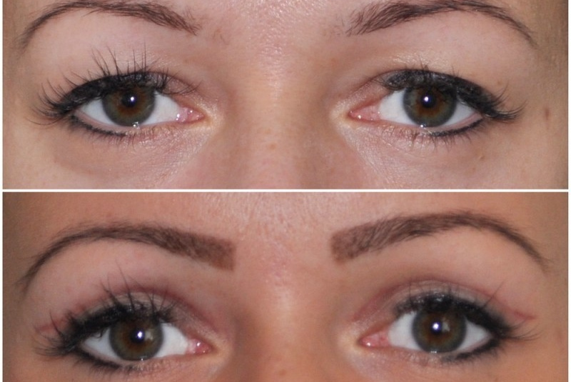 Galéria - obrázky / Operácia viečok - foto Galéria - obrázky / Operácia viečok - foto