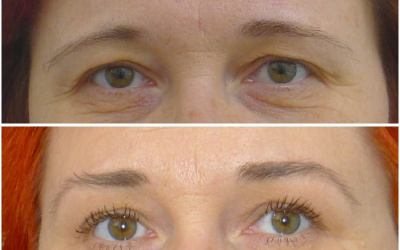 Elevácia obočia bez úpravy viečok