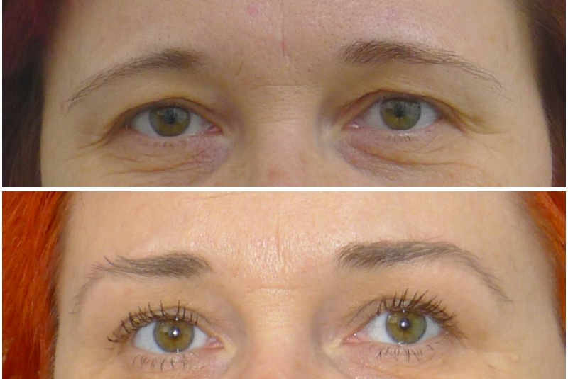 Elevácia obočia bez úpravy viečok Elevácia obočia bez úpravy viečok