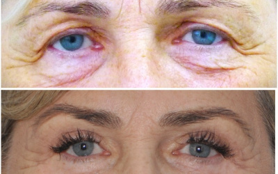 Horné + dolné viečka + obočie