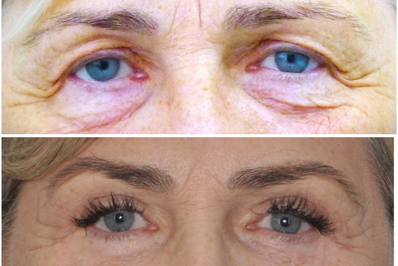 Horné + dolné viečka + obočie