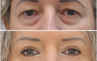 Horné + dolné viečka + obočie Horné + dolné viečka + obočie