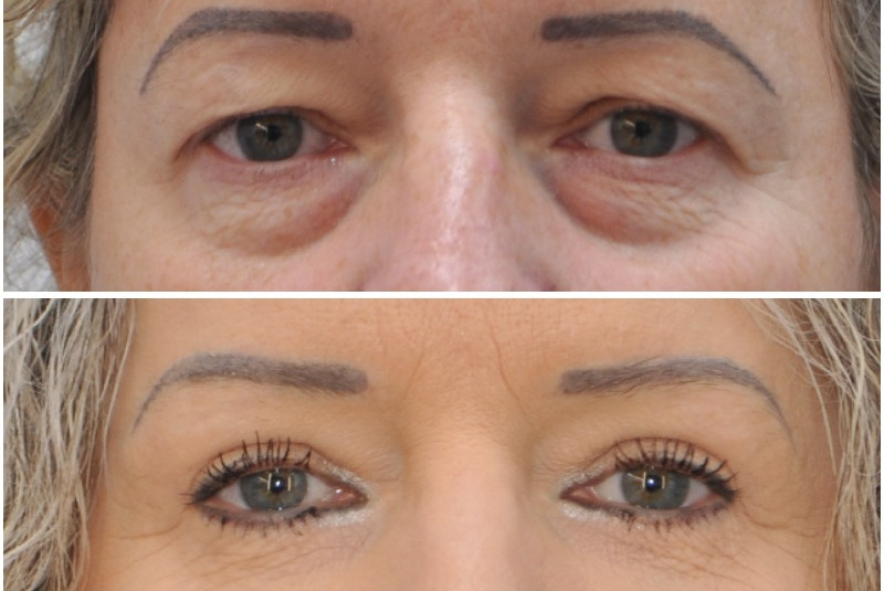 Horné + dolné viečka + obočie