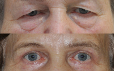 Horné + dolné viečka + xantelazmy Horné + dolné viečka + xantelazmy