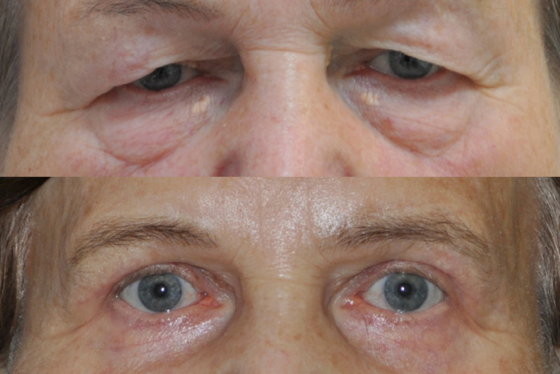 Horné + dolné viečka + xantelazmy Horné + dolné viečka + xantelazmy