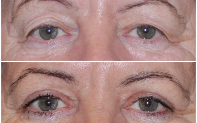 Horné viečka Horné viečka