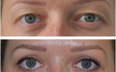 Horné viečka, mladá pacientka