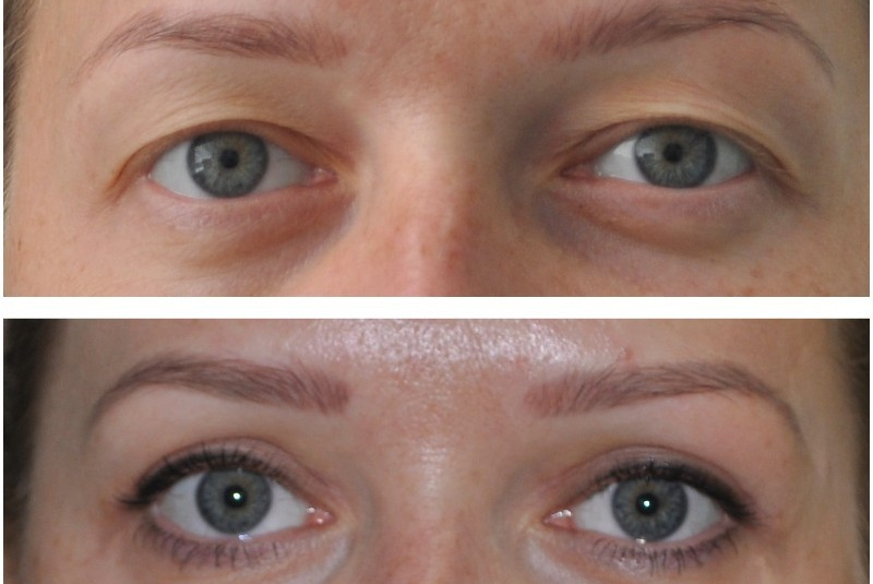 Horné viečka, mladá pacientka Horné viečka, mladá pacientka