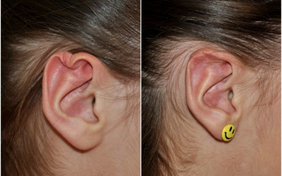 Poúrazová deformita Poúrazová deformita