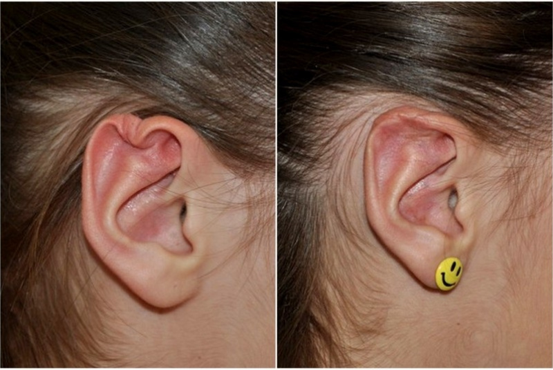 Poúrazová deformita Poúrazová deformita